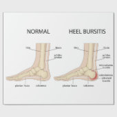 Haglund-Deformität Geschenkpapier (Flach)