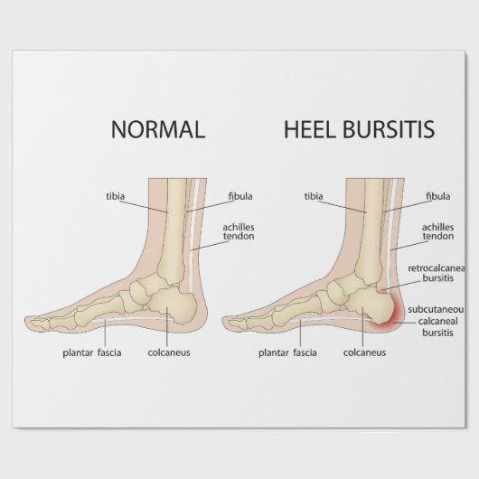Haglund-Deformität Geschenkpapier (Flach)