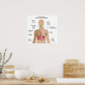 Hauptsymptome einer akuten HIV-Infektion Poster (Küche)
