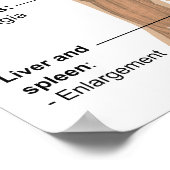 Hauptsymptome einer akuten HIV-Infektion Poster (Ecke)