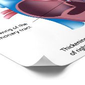 Herzerkrankung Poster (Ecke)