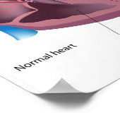 Herzhypertrophie Poster (Ecke)