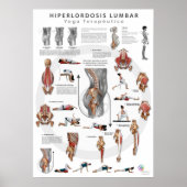 Hiperlordosis - Definition, Ursachen und Poster (Vorne)