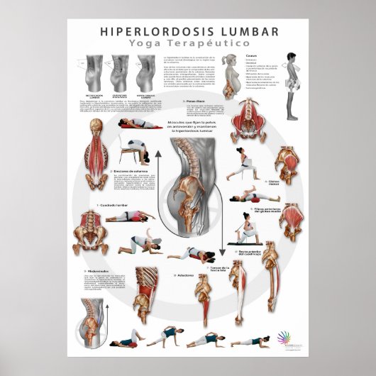 Hiperlordosis - Definition, Ursachen und Poster (Vorne)