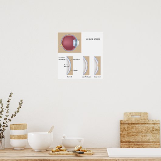 Hornhautgeschwüre Augenerkrankung Poster (Küche)