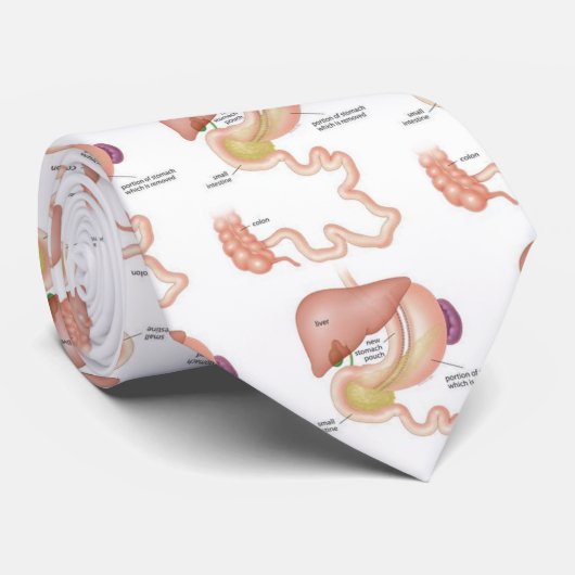 Hülsegastrectomy-Krawatte Krawatte (Gerollt)