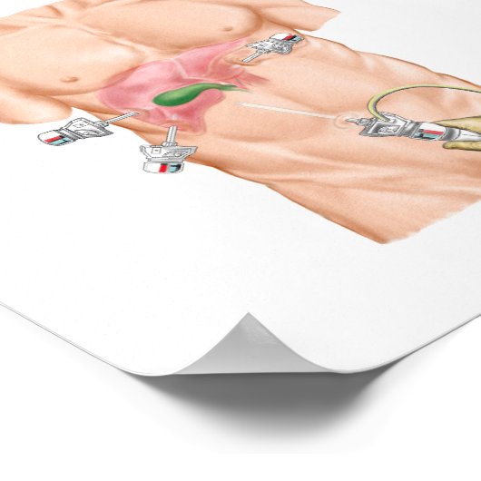 Illustration der Cholektomie Poster (Ecke)