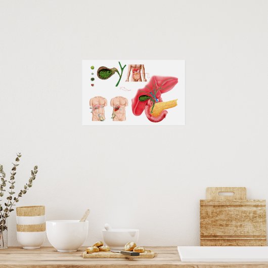 Illustration der Cholektomie Poster (Küche)