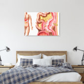 Illustration der Divertikulose im Kolon Leinwanddruck (Insitu (Schlafzimmer))