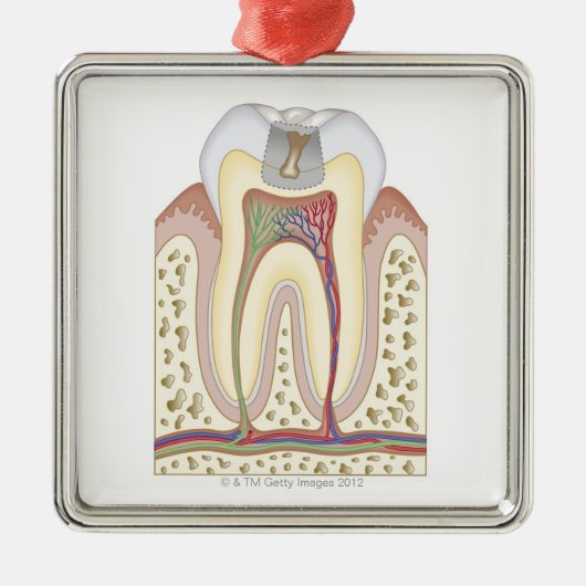 Illustration des Zahnverfalls Silbernes Ornament (Vorne)