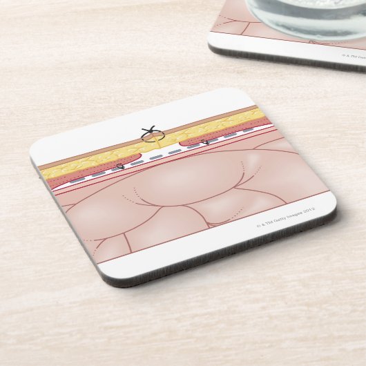 Illustration einer Hernie Getränkeuntersetzer (Linke Seite)