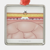 Illustration einer Hernie Silbernes Ornament (Vorne)