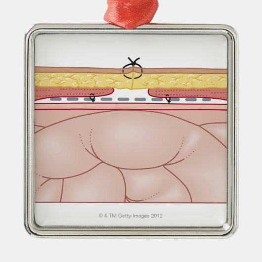 Illustration einer Hernie Silbernes Ornament (Vorne)