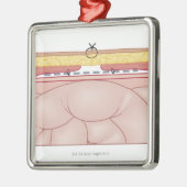 Illustration einer Hernie Silbernes Ornament (Links)