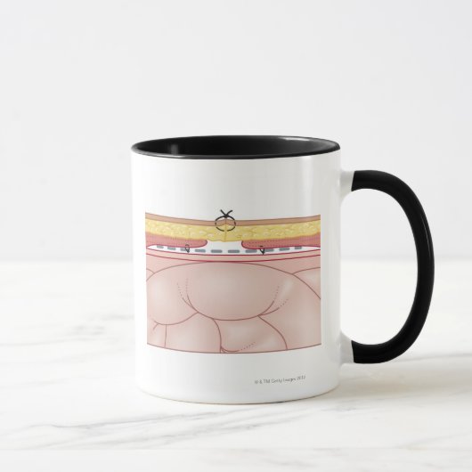 Illustration einer Hernie Tasse (Rechts)
