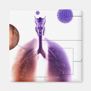 Illustration eines Asthmaanfalls vom Blütenstaub Magnet