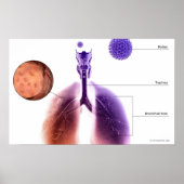 Illustration eines Asthmaanfalls von Pollen Poster (Vorne)