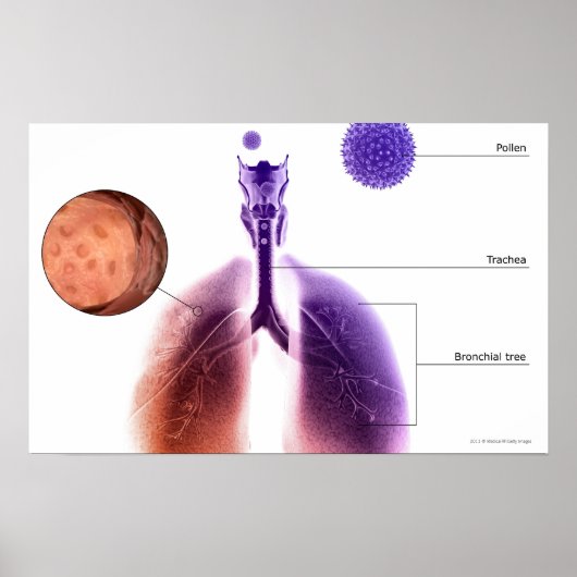 Illustration eines Asthmaanfalls von Pollen Poster (Vorne)