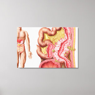 Illustration von Diverticulosis im Doppelpunkt Leinwanddruck