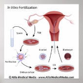 In vitro Fertilisation (IVF) Verfahren gekennzeich Poster (Vorne)