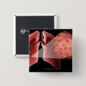 Inflammed Fluglinie während eines Asthmaanfalls Button (Vorne & Hinten)
