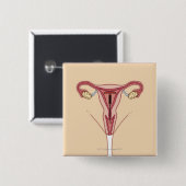 Intrauterinjektor Button (Vorne & Hinten)