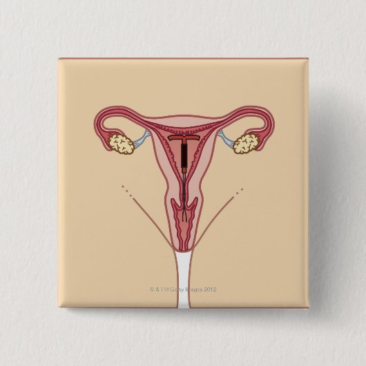 Intrauterinjektor Button (Vorderseite)
