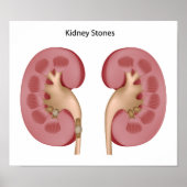 Kidney Stone Poster (Vorne)