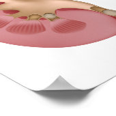 Kidney Stone Poster (Ecke)