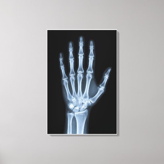 Klinisches Röntgenbild der Hand Leinwanddruck (Vorderseite)
