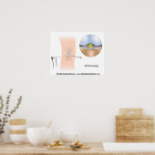 Kniearthroskopie-Diagramm Poster (Küche)