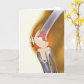 Knieersatz. Farbiger Röntgenstrahl eines Karte (Gelbe Blume)