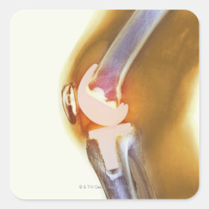 Knieersatz. Farbiger Röntgenstrahl eines Quadratischer Aufkleber