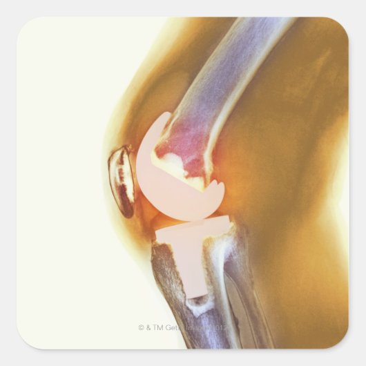 Kniegelenksersatz. Farbige Röntgenaufnahme eines g Quadratischer Aufkleber (Vorderseite)