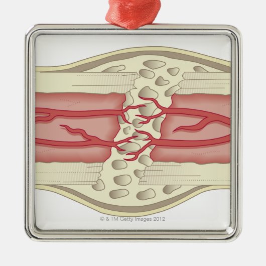 Knochen, der 2 sich repariert ornament aus metall (Vorne)