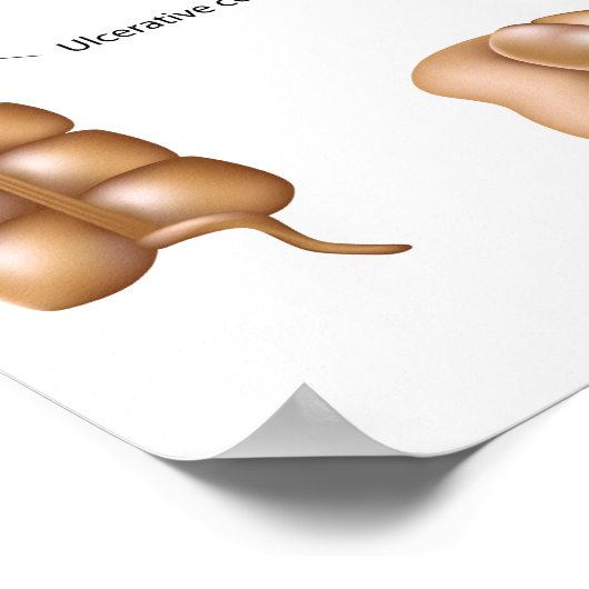 Kolonpathologie Poster (Ecke)