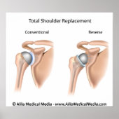 Konventionelle oder umgekehrte Gesamtersatzschulte Poster (Vorne)