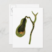 Konzeptbild von Gallstones im Gall Postkarte (Vorne/Hinten)