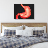 Konzeptuelles Bild eines peptischen Ulkus im Magen Leinwanddruck (Insitu (Schlafzimmer))