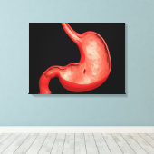 Konzeptuelles Bild eines peptischen Ulkus im Magen Leinwanddruck (Insitu (Holzboden))