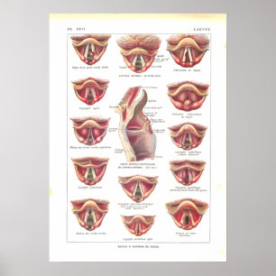 Krankheiten der Kehlkopf-Anatomie-Plakat-Franzosen Poster