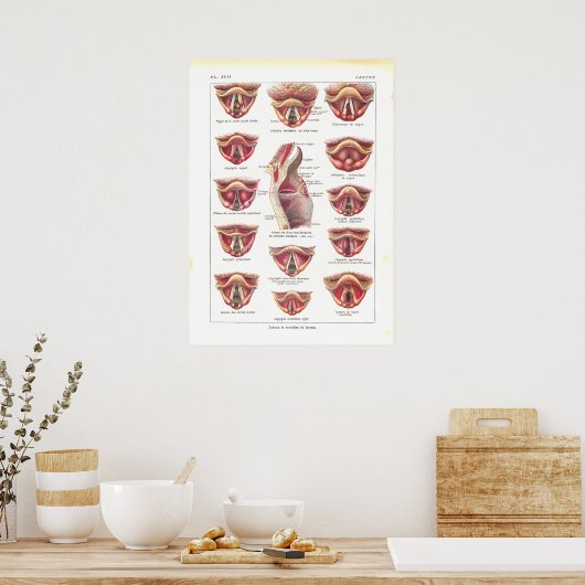 Krankheiten des Larynx Anatomy Poster Französisch (Küche)