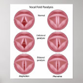 Lähmung der Stimmzange Poster (Vorne)