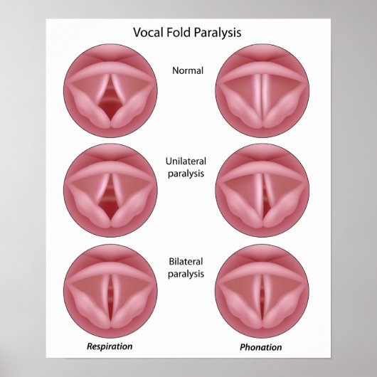 Lähmung der Stimmzange Poster (Vorne)