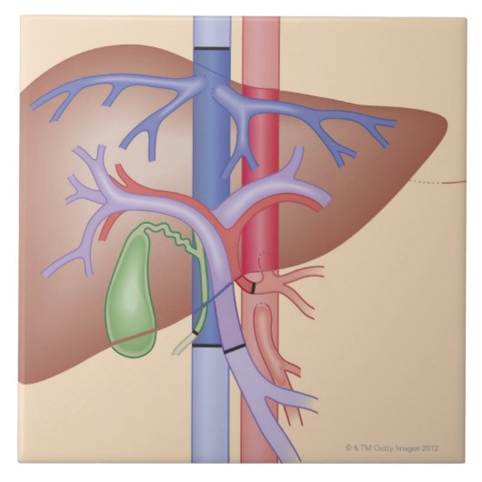 Leber-Transplantations-Verfahren Fliese (Vorderseite)