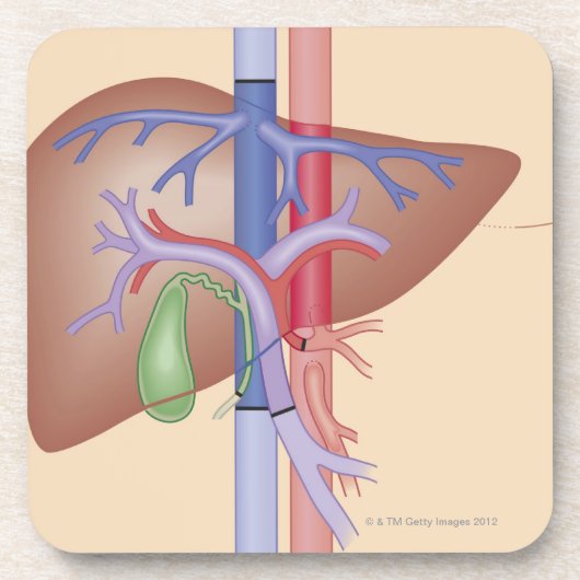 Leber-Transplantations-Verfahren Untersetzer (Vorderseite)
