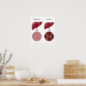 Lebererkrankung Zirrhose Poster (Küche)