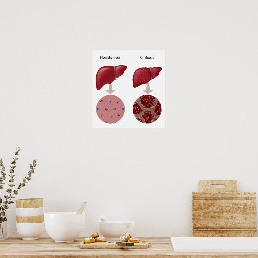 Lebererkrankung Zirrhose Poster (Küche)