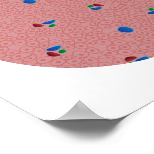 Lebererkrankung Zirrhose Poster (Ecke)