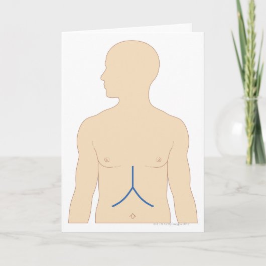 Lebertransplantation Karte (Vorderseite)